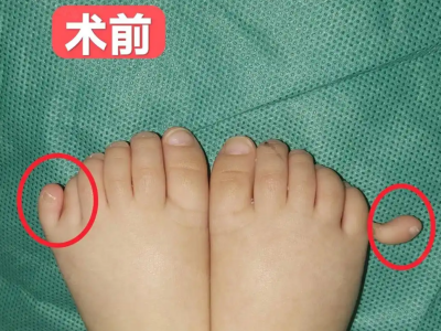 Att välja skor till en baby med extra tår är så svårt! Efter operationen, att...